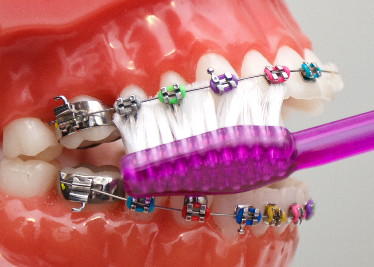 How to Clean Your Teeth with Braces