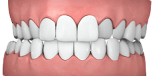 Common teeth problems: Crossbite.