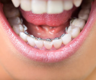 All about lingual braces.