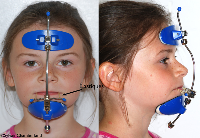 Face mask front and profile view Orthodontist
