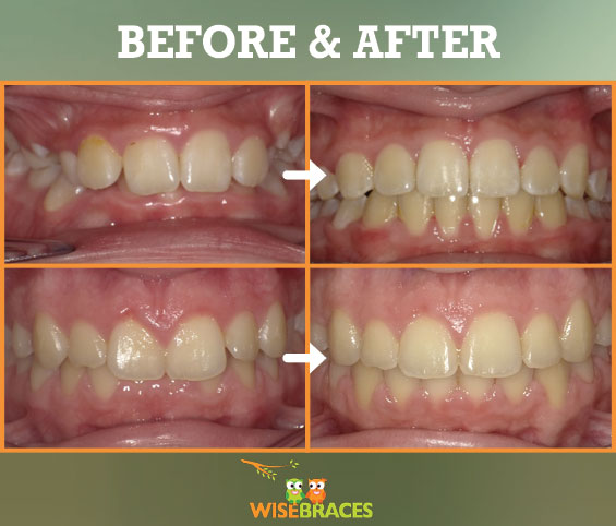 Orhtodontics - Before and After - WiseBraces