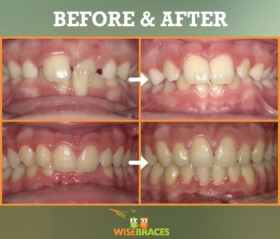 Orhtodontics - Before and After - WiseBraces